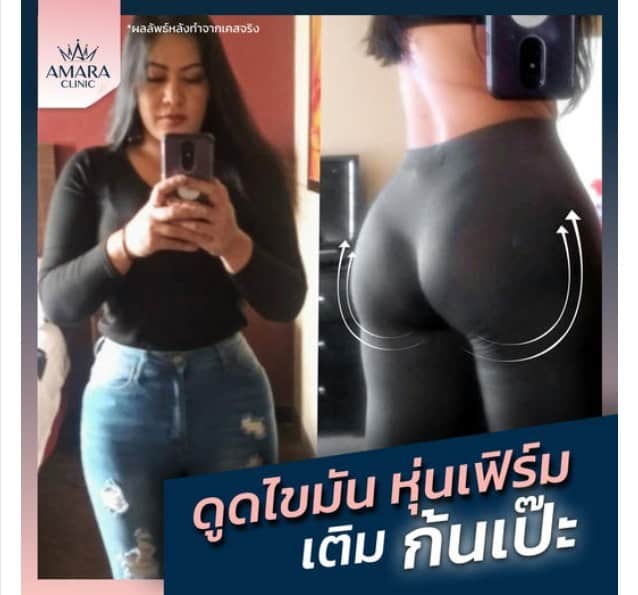 เติมไขมันก้น