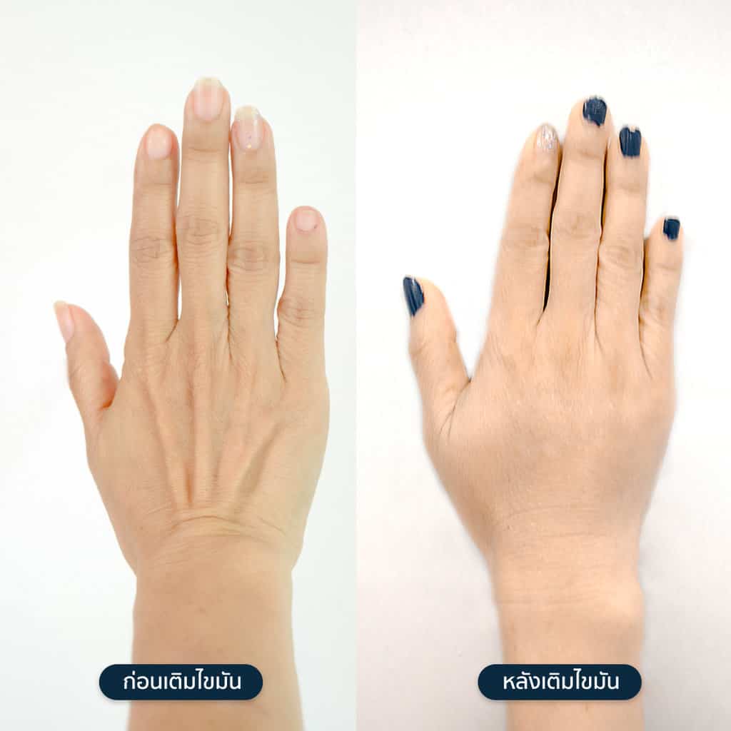 เติมไขมันมือ