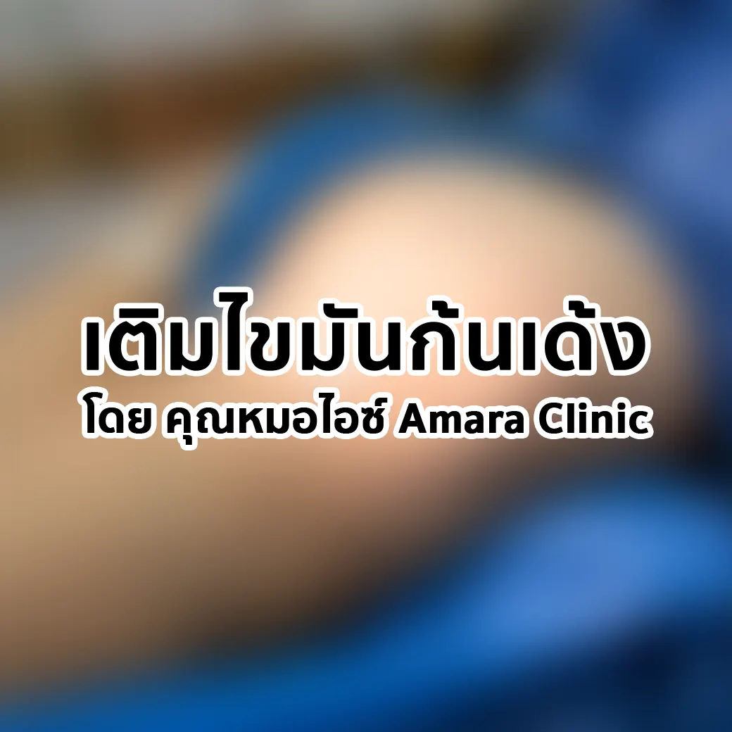 เติมไขมันก้นเด้ง